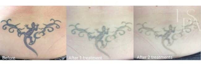 Laser Tattoo Removal in Lethbridge