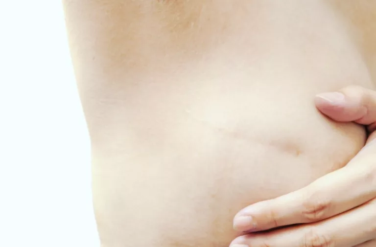 Breast Reduction in Lethbridge