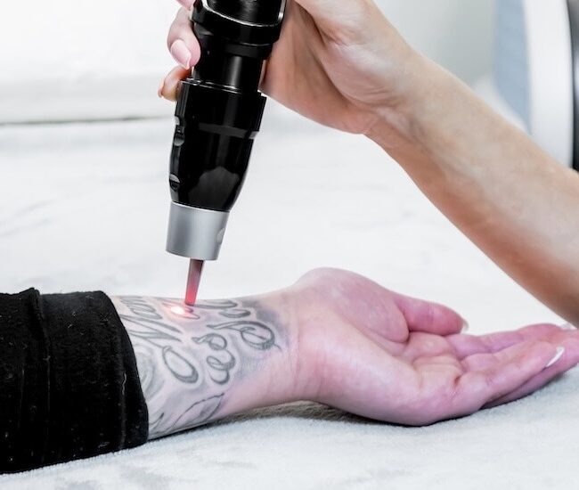 laser tattoo removal in Lethbridge