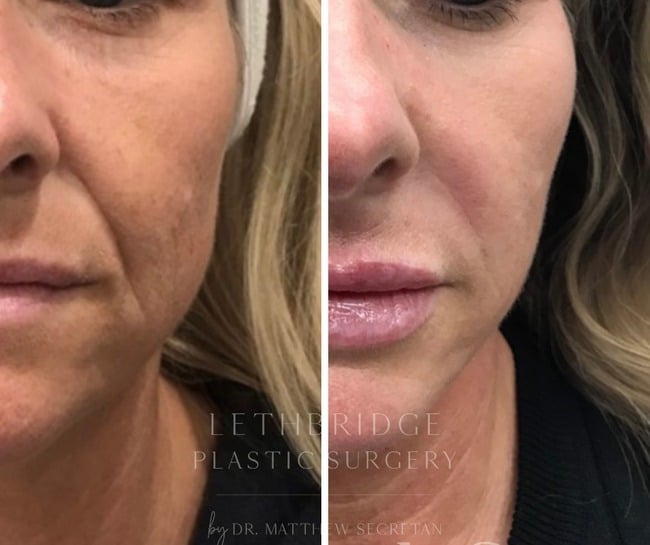 Cosmetic filler and Botox Injections in Lethbridge, Alberta