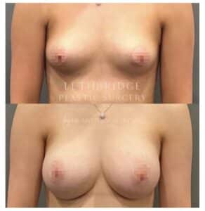 breast implants by Dr. Secretan in Lethbridge