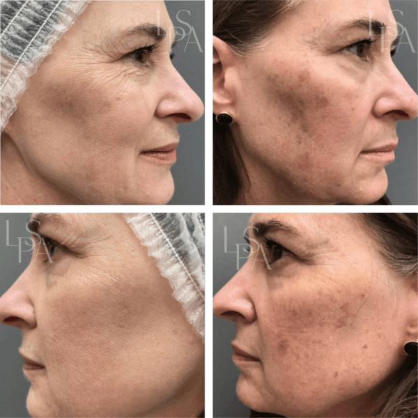 Before & After of skin health on female patient