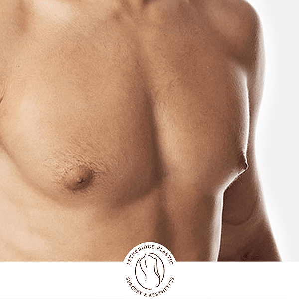 Effective Tips on Shaping the Chest after Gynecomastia Surgery