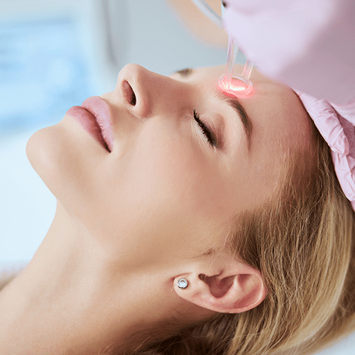 laser facial for hyperpigmentation, acne scarring and wrinkles