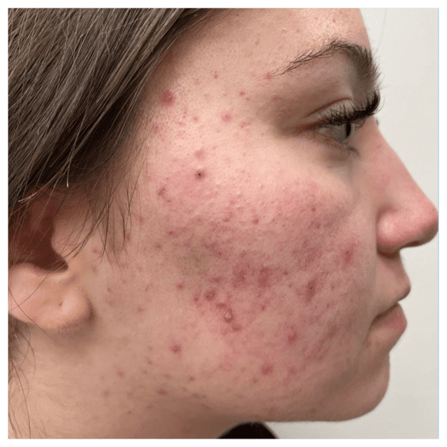 cystic acne scars treatment in Lethbridge, Alberta