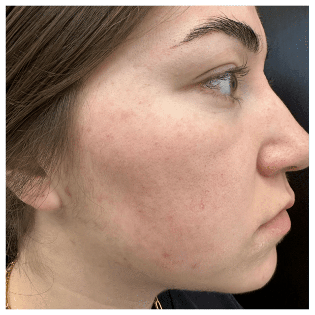 laser skin resurfacing after acne scars