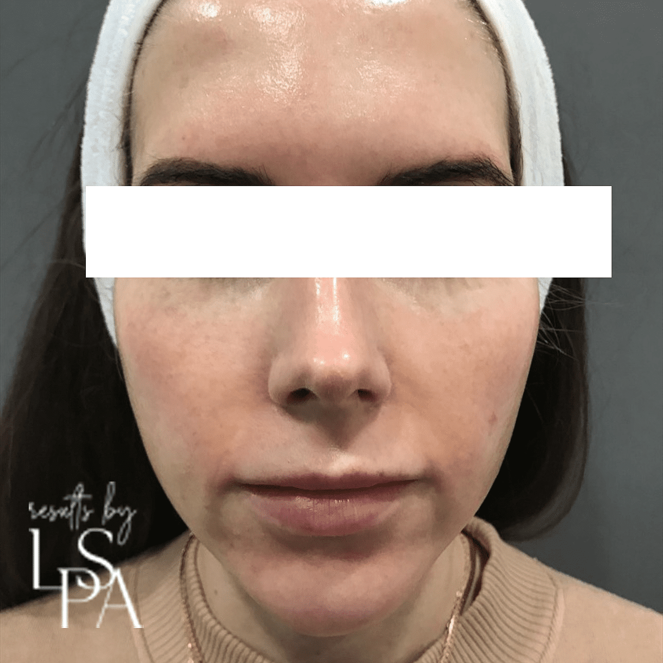 brown spots clear complexion