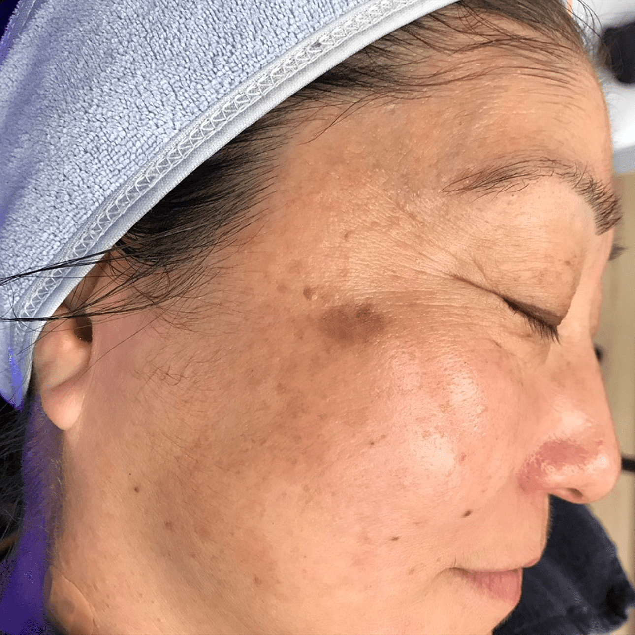 age spots removal treatment before