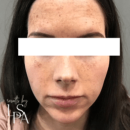 brown spots clear complexion