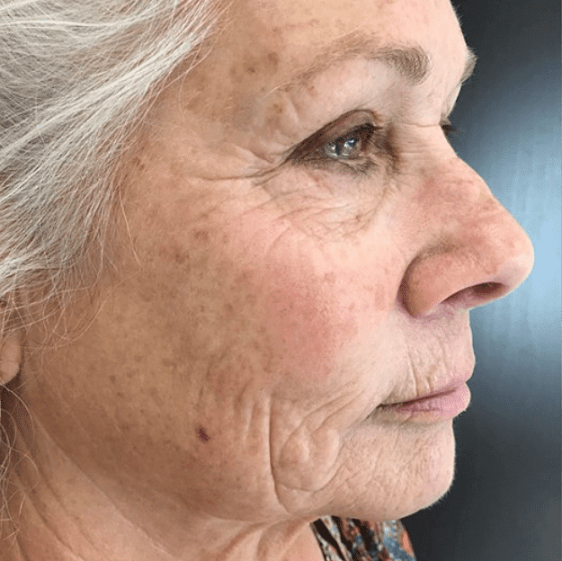 skin rejuvenation aging skin laser resurfacing CO2