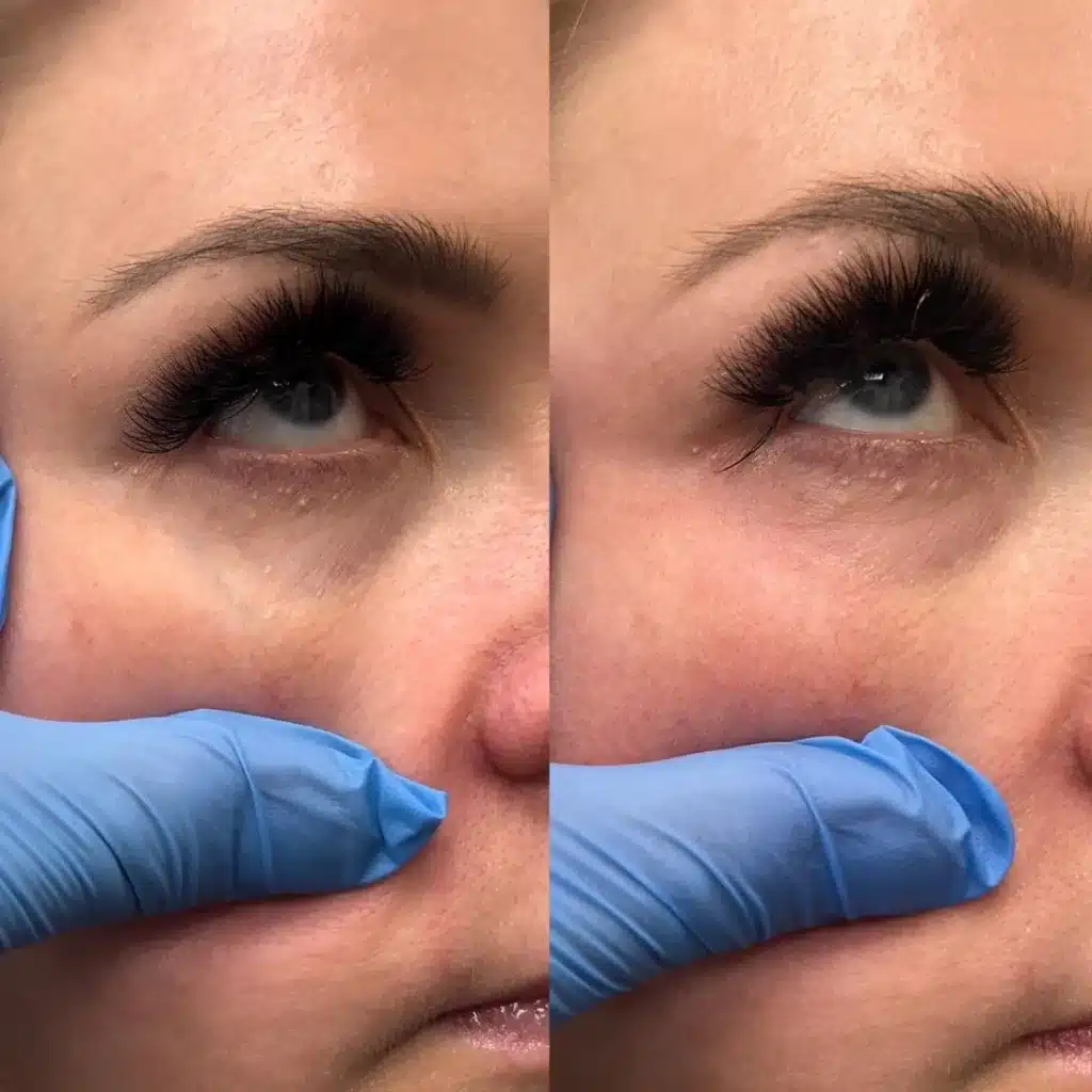 Before and after look at a woman's eyes after Periorbital Vein Treatment