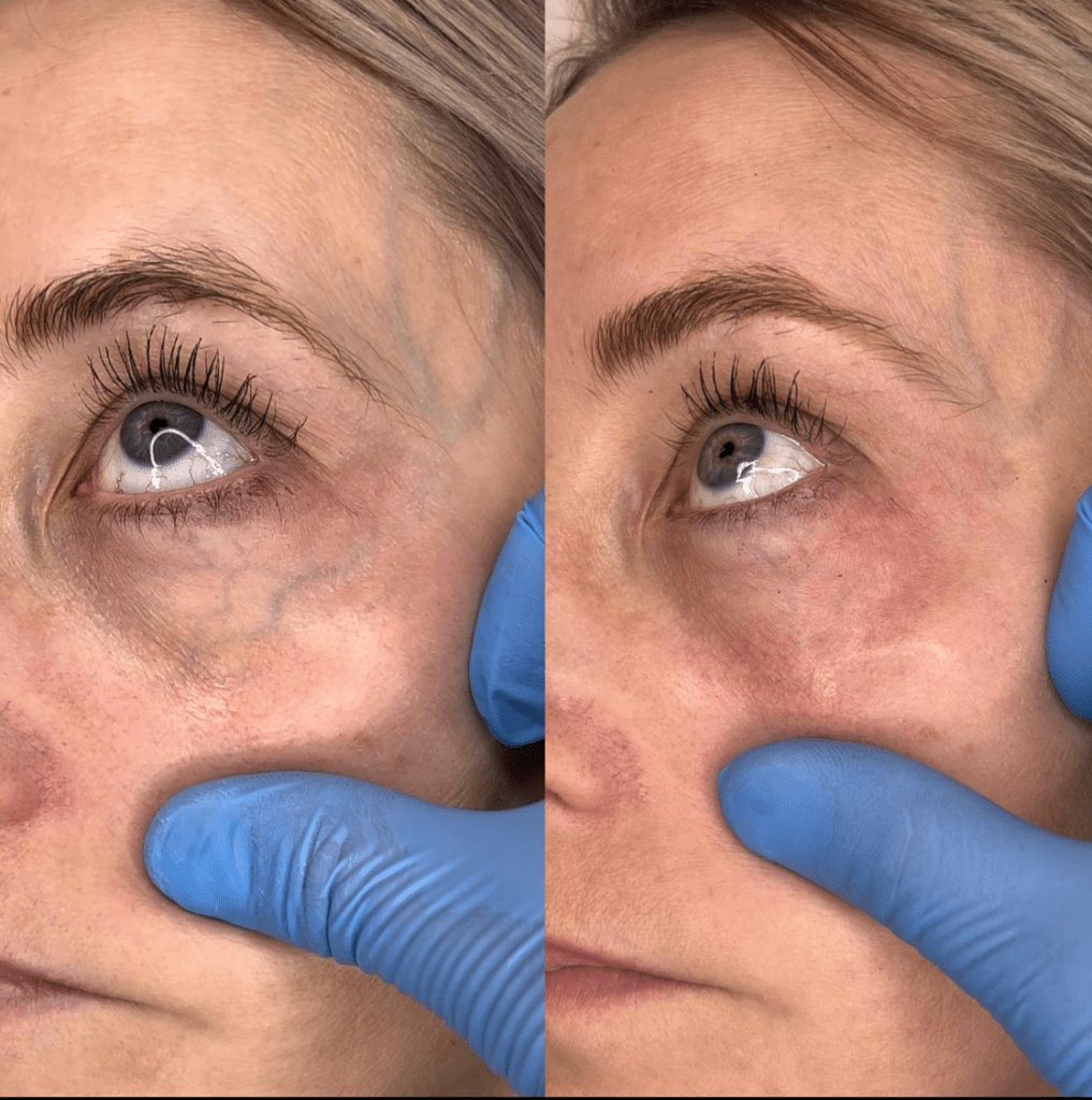 Periorbital Vein Treatment before and after look
