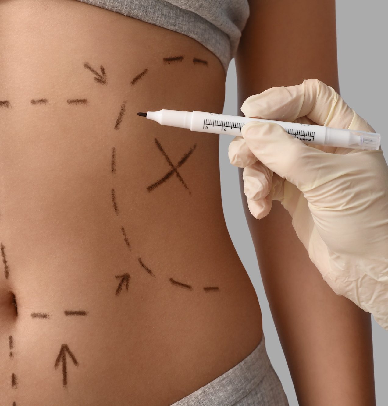 Gloved hand marking abdominal liposuction treatment areas on a woman's torso