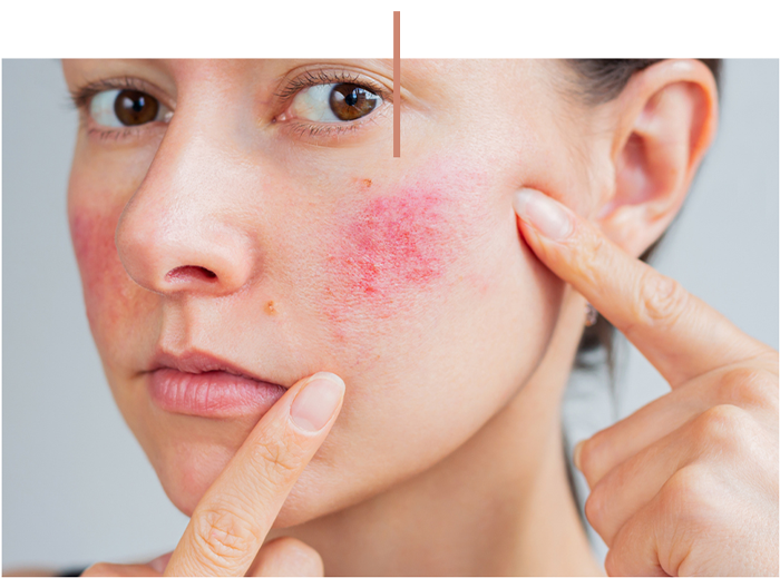 Close-up of a woman examining a red skin rash on her cheek