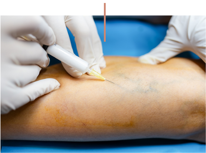 Gloved medical professional inserting needle into a patient’s leg during injection procedure