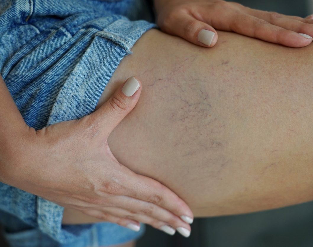 Hands examining a person's thigh with visible spider veins