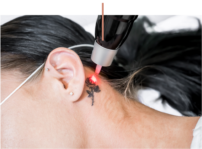 Close-up of a woman receiving laser tattoo removal behind the ear