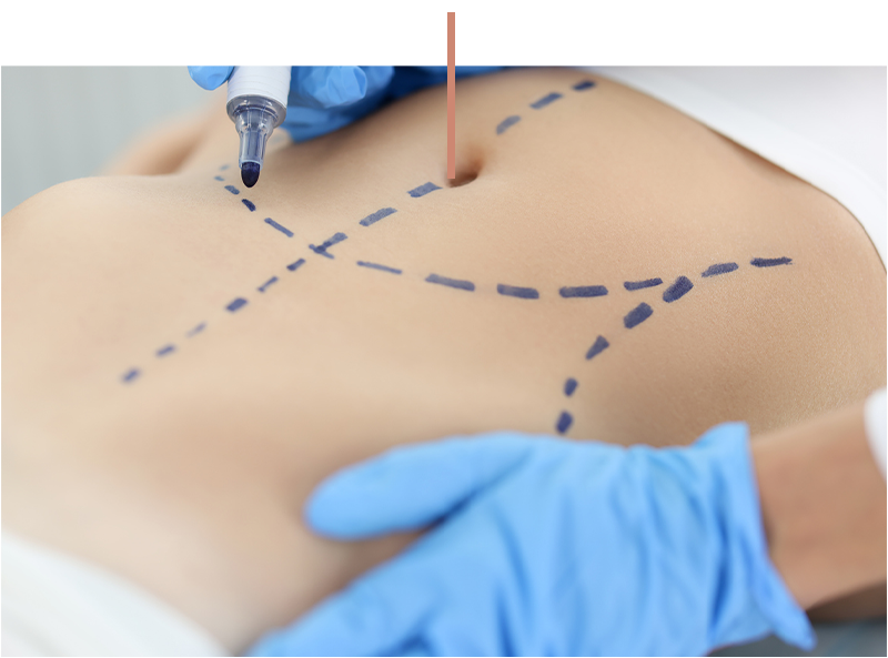 Close-up of marked abdomen during cosmetic surgery planning with gloved hands