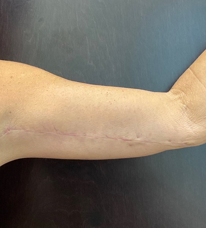 Close-up of a person's forearm with a healing surgical scar near the wrist
