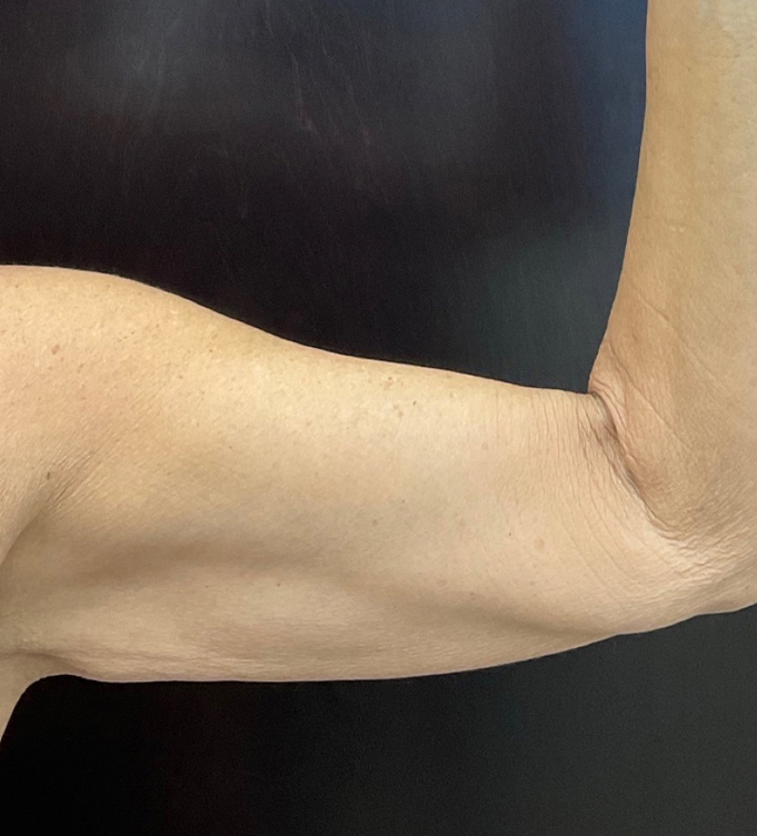 Close-up of a person's bent arm showing bicep and forearm against a black background