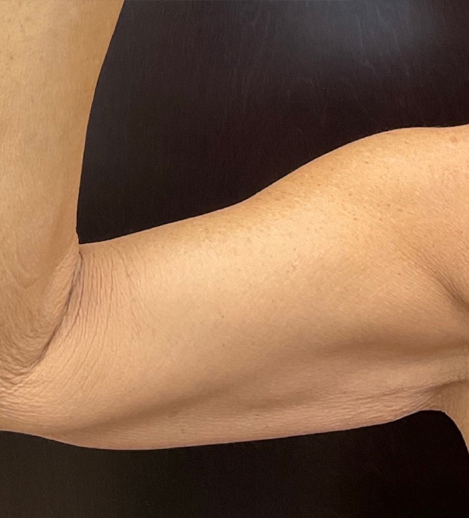 Close-up of a flexed arm showing biceps and skin texture against a black background