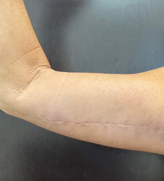 Close-up of a forearm with a surgical scar