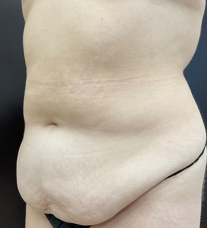 Side view of a person's lower torso and abdomen in black underwear against a dark background
