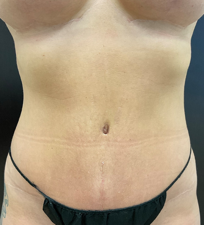 Close-up of a woman's torso with abdominal skin and black underwear