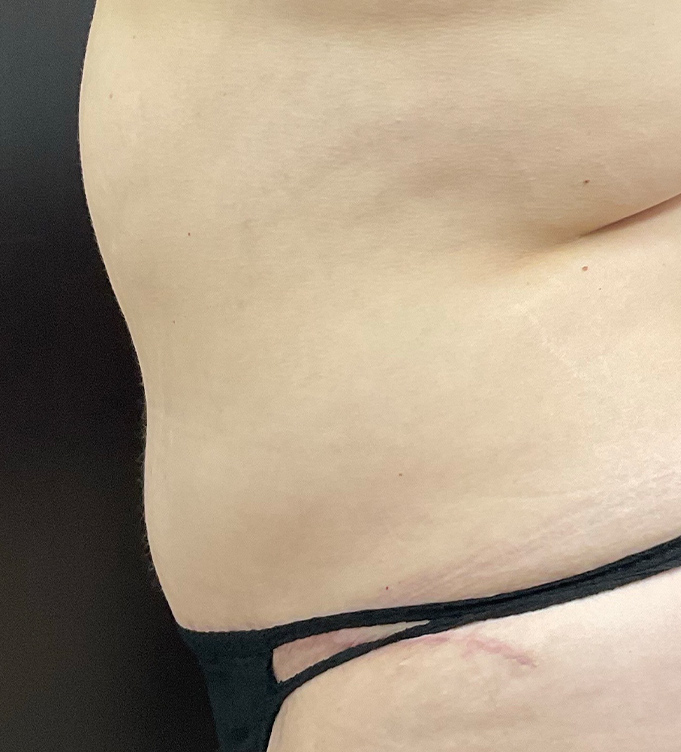 Close-up of a person’s torso wearing black underwear against a dark background