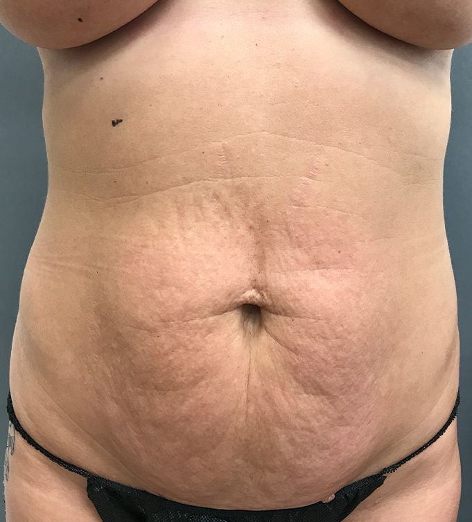 Front view of a woman’s torso and abdomen with loose skin and stretch marks