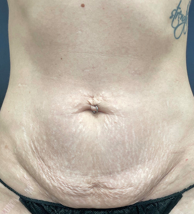 Close-up of a person’s lower abdomen with belly button piercing and stretch marks