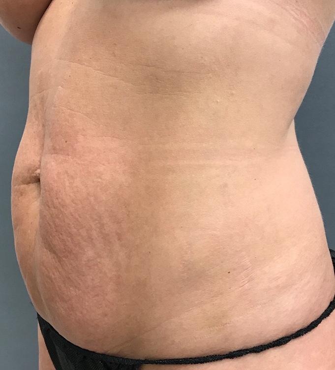 Side view of a woman’s abdomen with stretch marks and black underwear