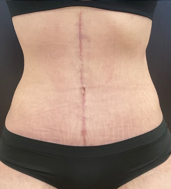 Close-up of a woman’s abdomen with a vertical surgical scar and black underwear