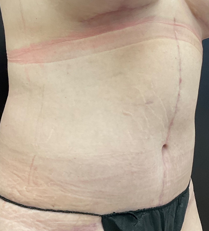 Close-up of a person's abdomen with surgical scars and black underwear