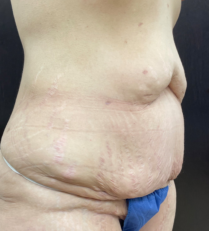 Side view of a person’s abdomen with visible skin folds and stretch marks