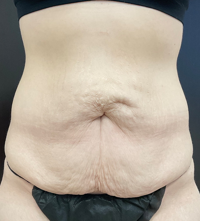 Close-up of a person’s abdomen with loose skin and black underwear