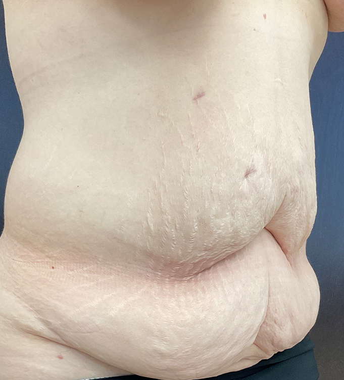Close-up of a person’s abdomen with visible stretch marks and skin folds