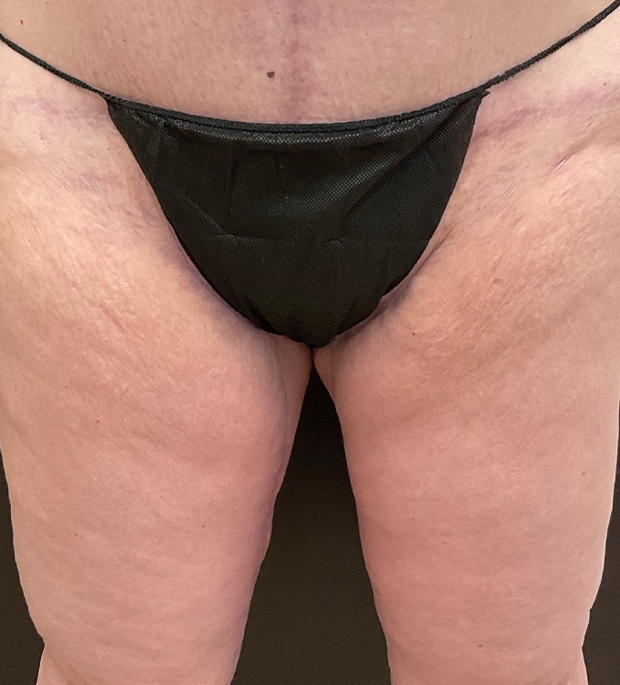 Close-up of a person wearing black underwear, showing upper thighs and hips