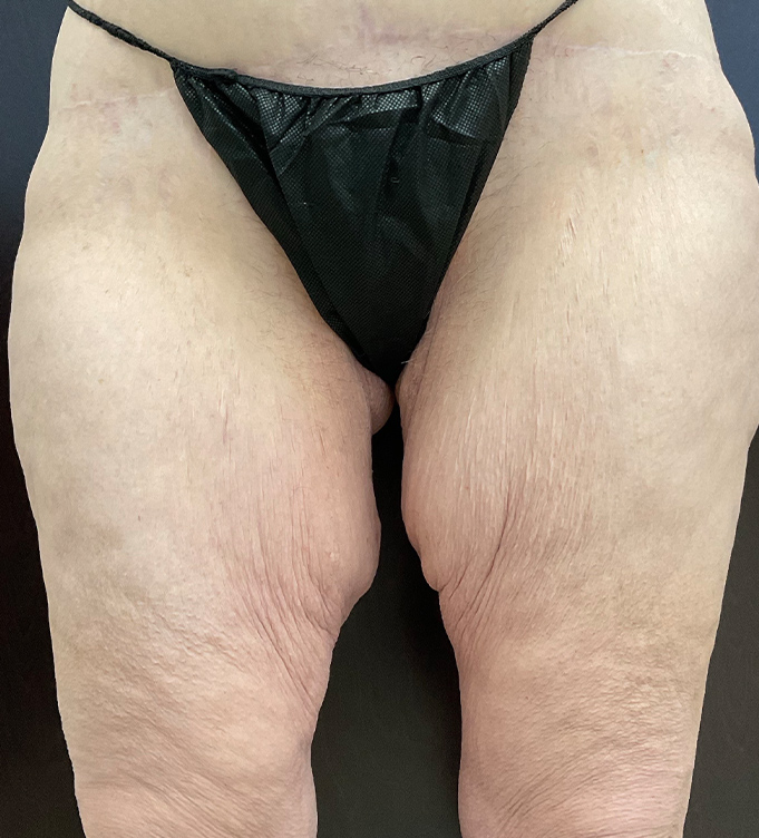 Close-up of a person’s thighs wearing black underwear